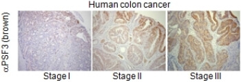 Human colon cancer